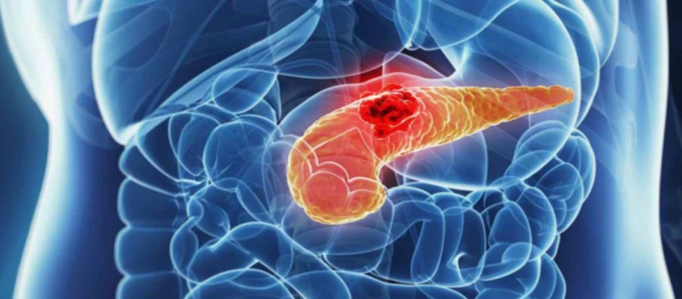 Καρκίνος στο πάγκρεας: Όλα τα «αθώα» συμπτώματα που πρέπει να προσέχετε